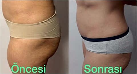 Bölgesel Zayıflama, İncelme Ankara