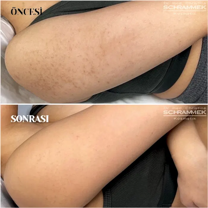 Green Peel Öncesi Sonrası