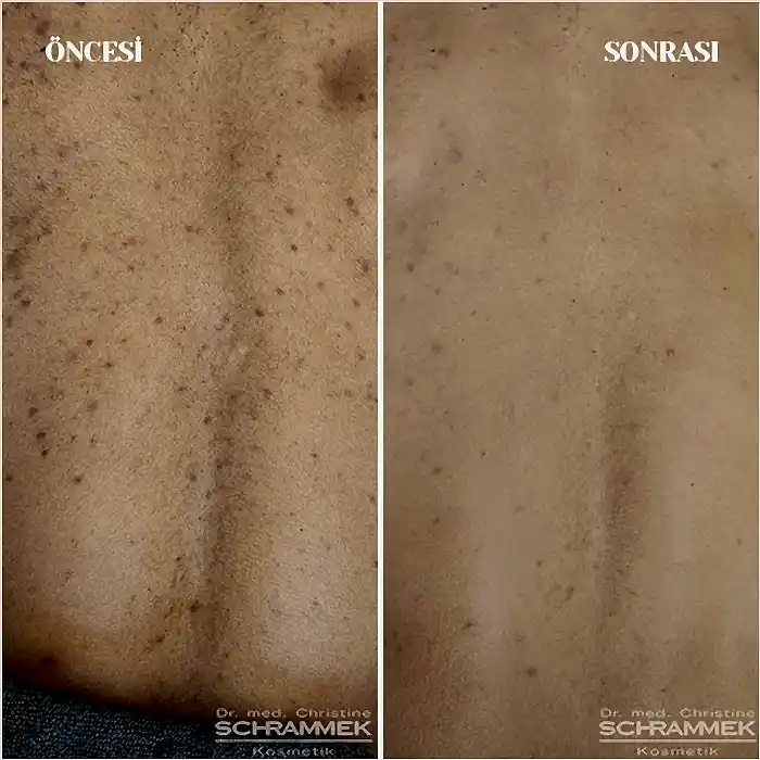 Green Peel Yaptıranlar