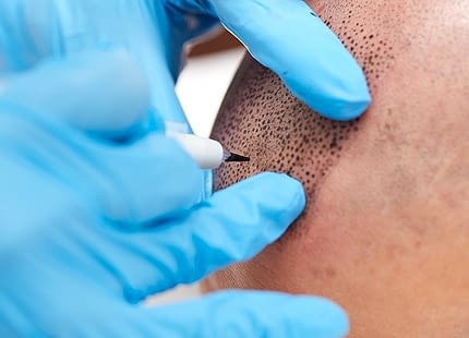 Saç Simülasyonu Sonrası Bakım ve Yıkama