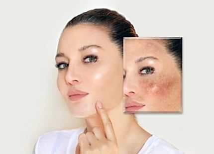 Yüzdeki Lekeler Nasıl Geçer?