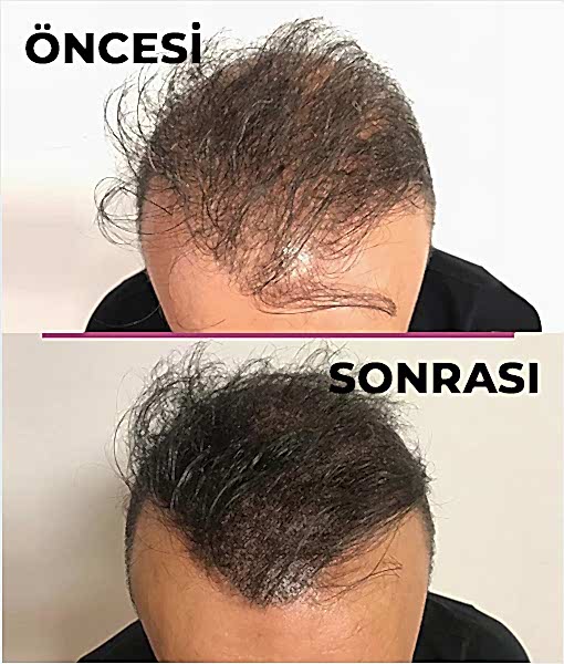 Saç Simülasyonu Ankara